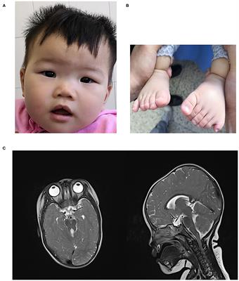 Case Report: Second Report of Joubert Syndrome Caused by Biallelic Variants in IFT74